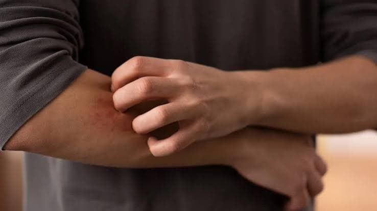 Dermatofilosi in crescita in Europa: Pregliasco rassicura sul basso rischio, ma avverte sui cambiamenti nei contagi
